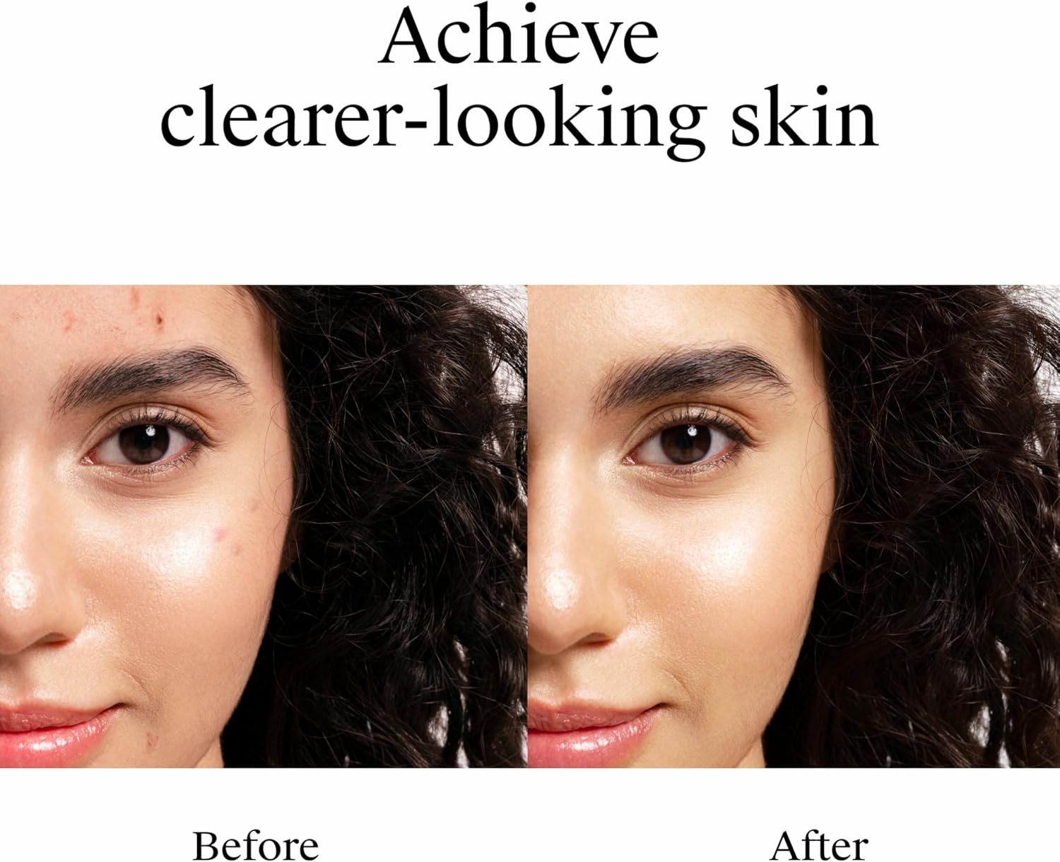 Clear Skin Acne Spot Gel